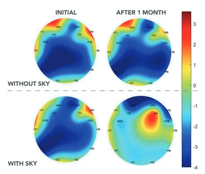 EEG brain maps of one student’s beta-wave activity, initially and after one month, without and with Sudarshan Kriya. After a month with Sudarshan Kriya the front-central region shows a red-yellow area of higher activity.